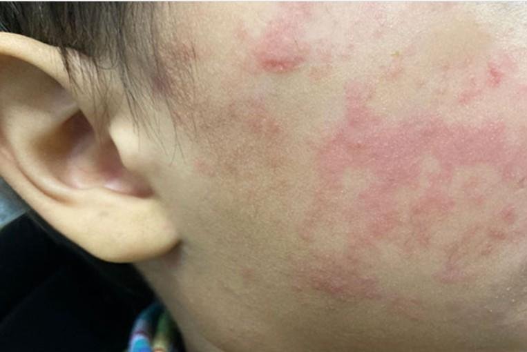 Measles is a highly contagious disease that was declared to be eradicated in 2000 in the United States because of widespread vaccinations. Photo courtesy Centers for Disease Control and Prevention.